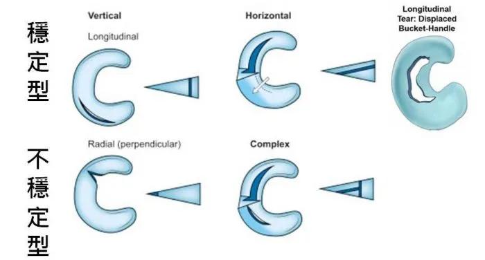 膝盖半月板手术后恢复的最佳方法,膝盖半月板替换手术康复训练