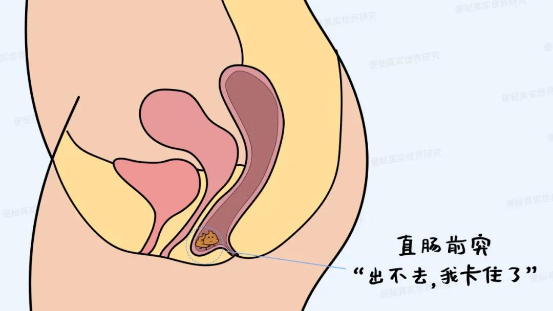 大便堵在肛门处，医生却让我多做这个动作