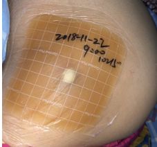 压疮液体敷料怎么用,压疮的治疗首选敷料