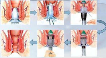 “肛”湖奇闻|今日份武功秘籍：痔微创手术——PPH