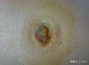 新生儿脐带有脓性分泌物中间发红,新生儿脐带发红怎么回事