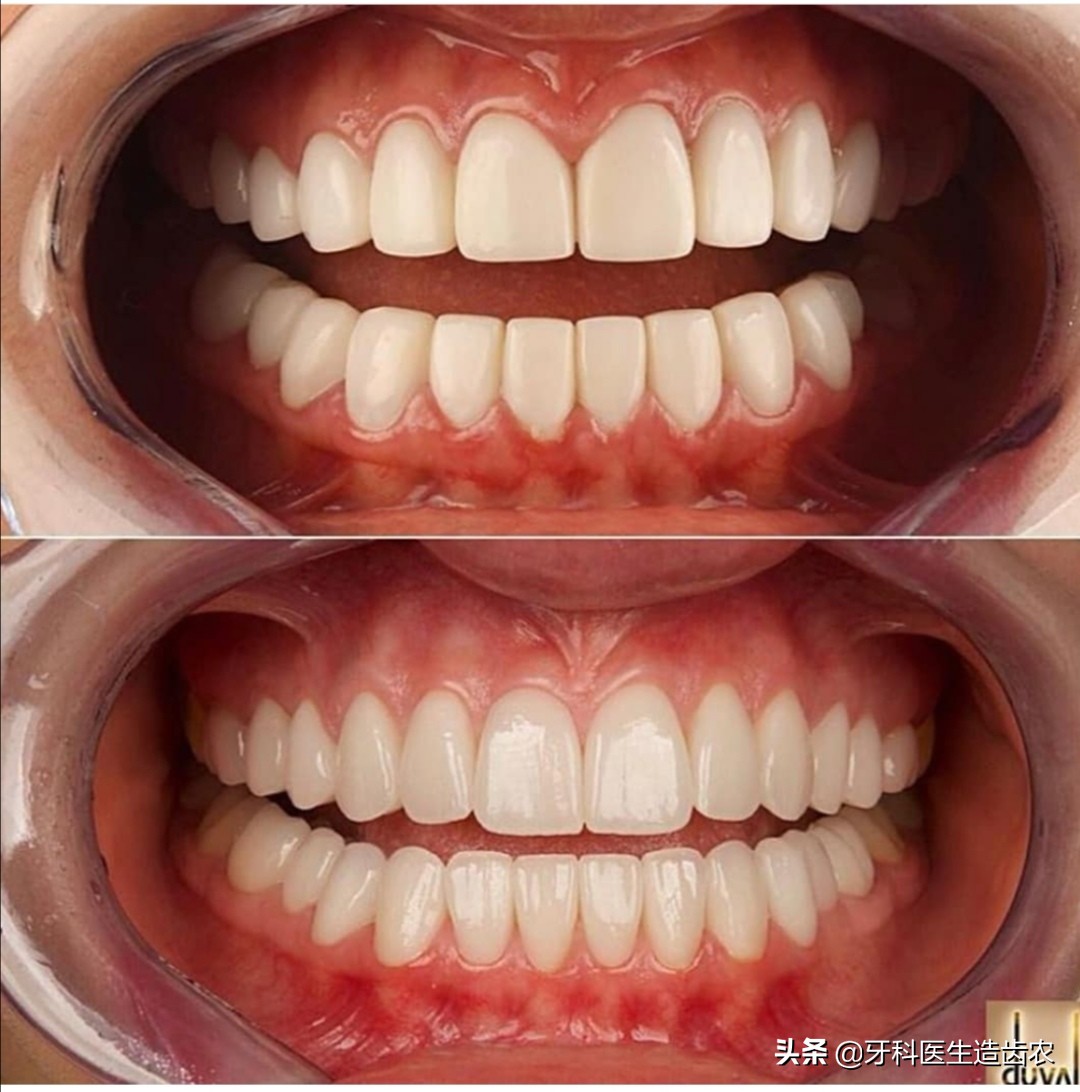 武汉烤瓷牙哪个医生做得最好,为什么医生不推荐烤瓷牙