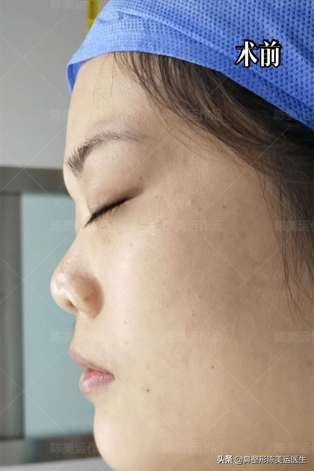 短塌鼻子可以做成直鼻吗,塌鼻子怎么能变成尖鼻子