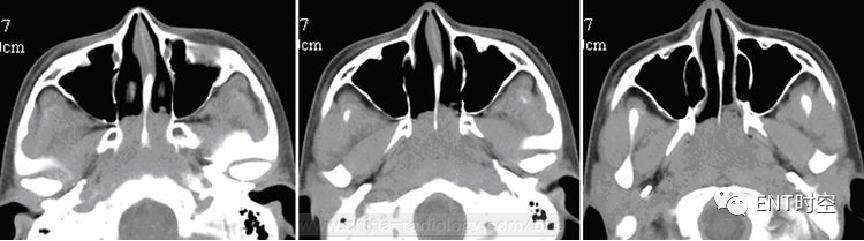 主任读片会：六大「喉部典型病例」大饱眼福