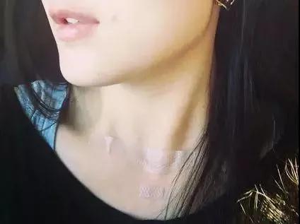 得了甲状腺女主播,主播甲状腺结节