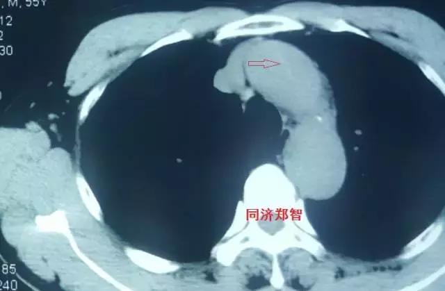 磁共振可以替代cta检查主动脉夹层,主动脉夹层cta上如何分辨真假腔