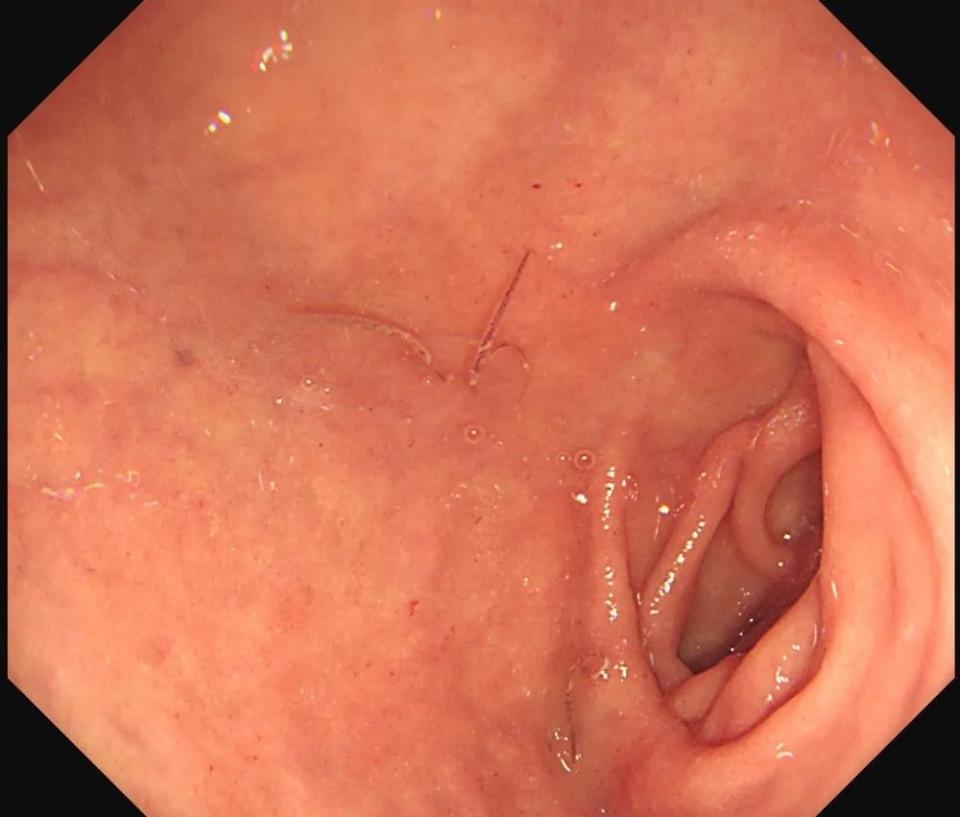 腹痛查不出病因全部检查都做了,腹痛查不出病因视频