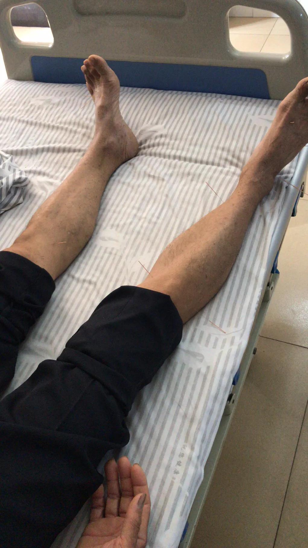 典型先兆性偏头痛怎么治,偏头痛左侧痛