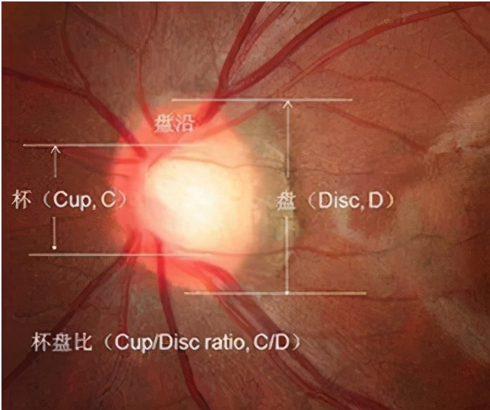 青光眼杯盘比增大机制,杯盘比大于多少怀疑青光眼