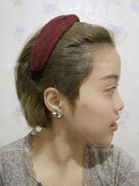 假体隆鼻科普之膨体隆鼻,膨体隆鼻整形效果怎么样