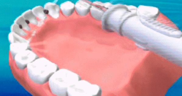 刷牙时牙龈出血怎么能有效的防护,刷牙牙龈出血只需要洗牙吗