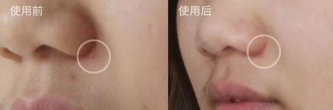 蜂胶消炎祛痘,蜂胶治疗皮癣吗