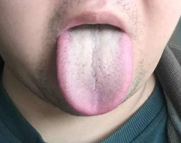 肾虚和湿气有关系吗,肾虚与湿热有关系吗