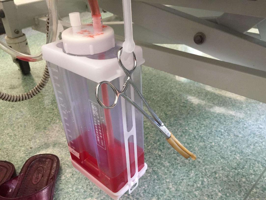 肺癌晚期有恶性胸腔积液,胸腔积液恶性是什么意思