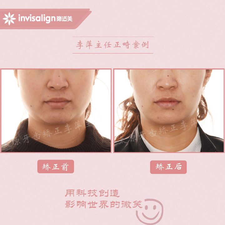 太原矫正牙齿需要做正颌吗,太原牙齿二次矫正