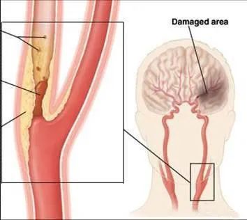 颈动脉斑块有哪些症状和危害,颈动脉有斑块能搓揉吗
