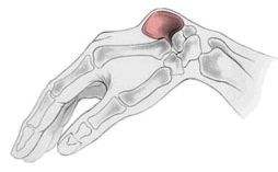 腱鞘囊肿复发还能按破吗,腱鞘囊肿按破了又长出来了怎么办