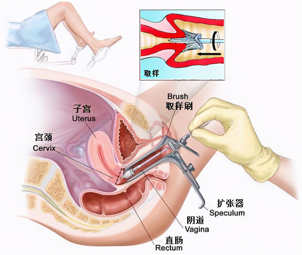 TCT、阴道镜、CIN、锥切（leep）都是什么意思？