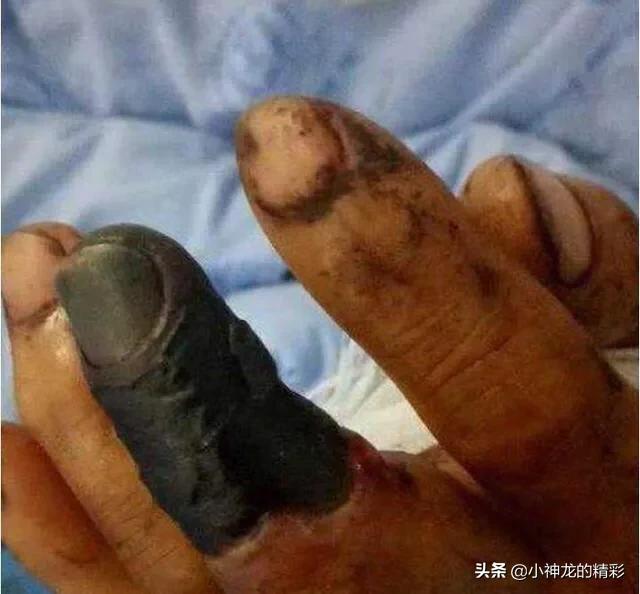 被五步蛇咬了真的不能走五步吗,为什么被五步蛇咬到只能走五步