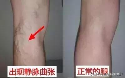 身上的青筋突然很明显是什么原因,身上青筋凸显可能是4种疾病