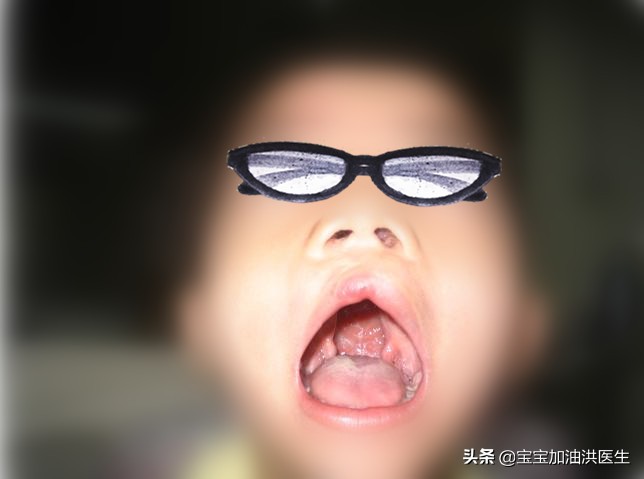 胚胎查出唇腭裂有什么后果,唇腭裂胎儿生下来怎么办