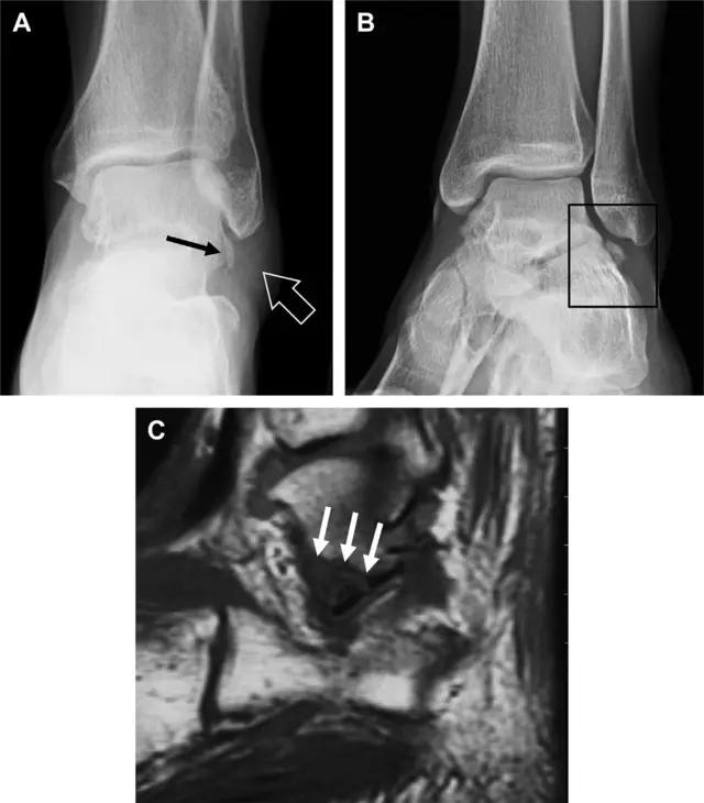 放射科夜班病例大全,放射科容易漏诊的骨折