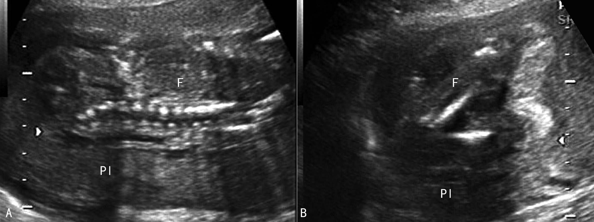 羊水彩超和普通彩超哪个更准,羊水异常的超声诊断