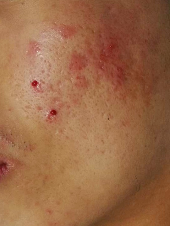 痘痘没了又长怎么解决,痘痘没了毛孔很大怎么办