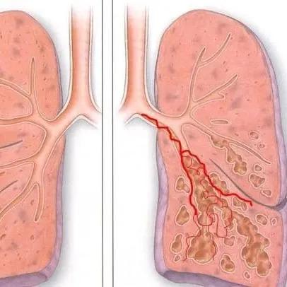 病人突然大咯血需要介入吗,医生抢救肺栓塞视频