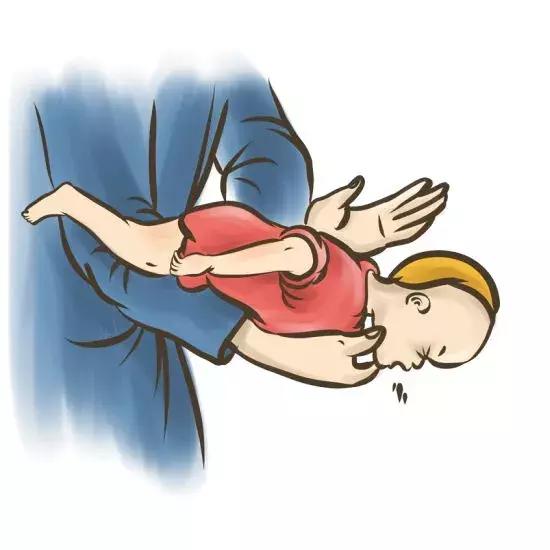 女子咳嗽20年竟因鸡骨头卡气管,大人痰卡住气管急救方法