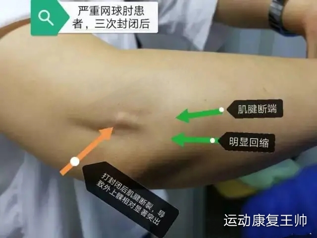 损伤疼痛，该不该打封闭呢？