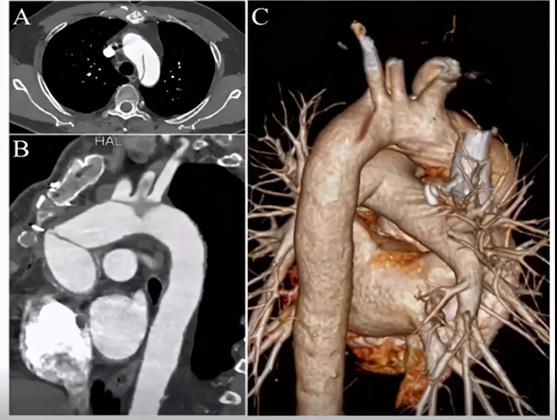 胡佳:升主动脉近端手术后新发弓部病变的腔内治疗