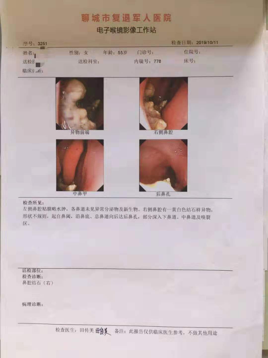 耳鼻喉科完成我院首例鼻内镜下巨大鼻石取出术