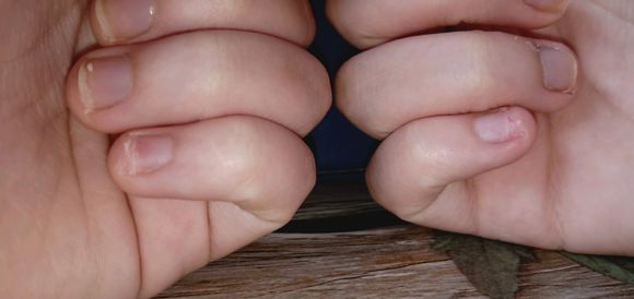 爱抠指甲是强迫症吗还是焦虑症,孩子抠指甲心理