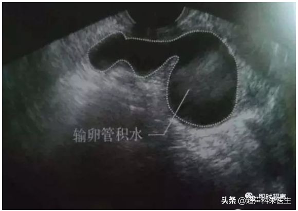 妇科常见疾病的超声诊断视频,超声常见疾病