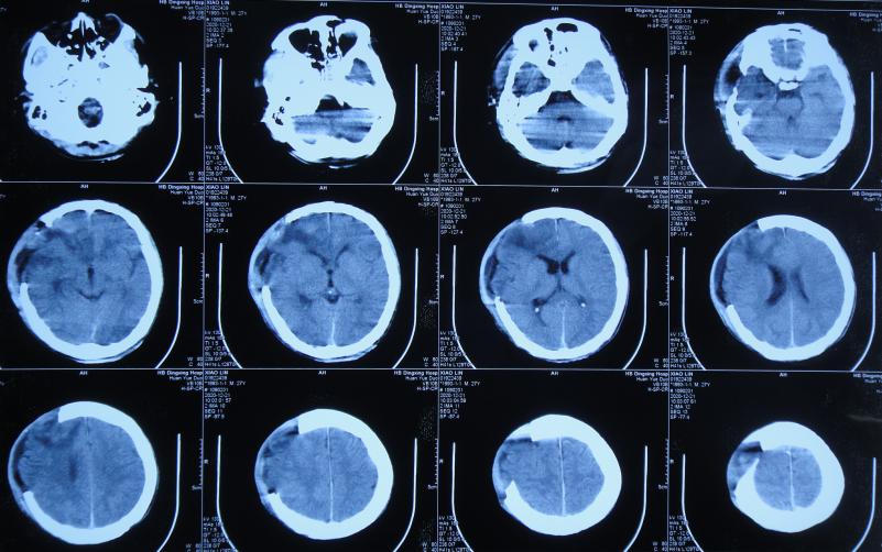 开颅手术后颅内细菌感染图片,外伤开颅手术后脑积液能恢复吗