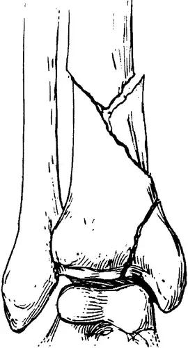 特殊骨折类型,特殊骨折体征