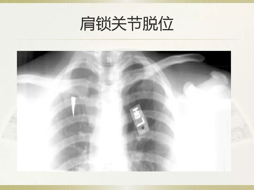 骨科x光片读片技巧,放射科骨科读片教程