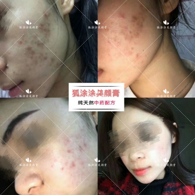 祛痘印痘坑用什么产品最好,什么产品祛痘印和祛痘最好最快