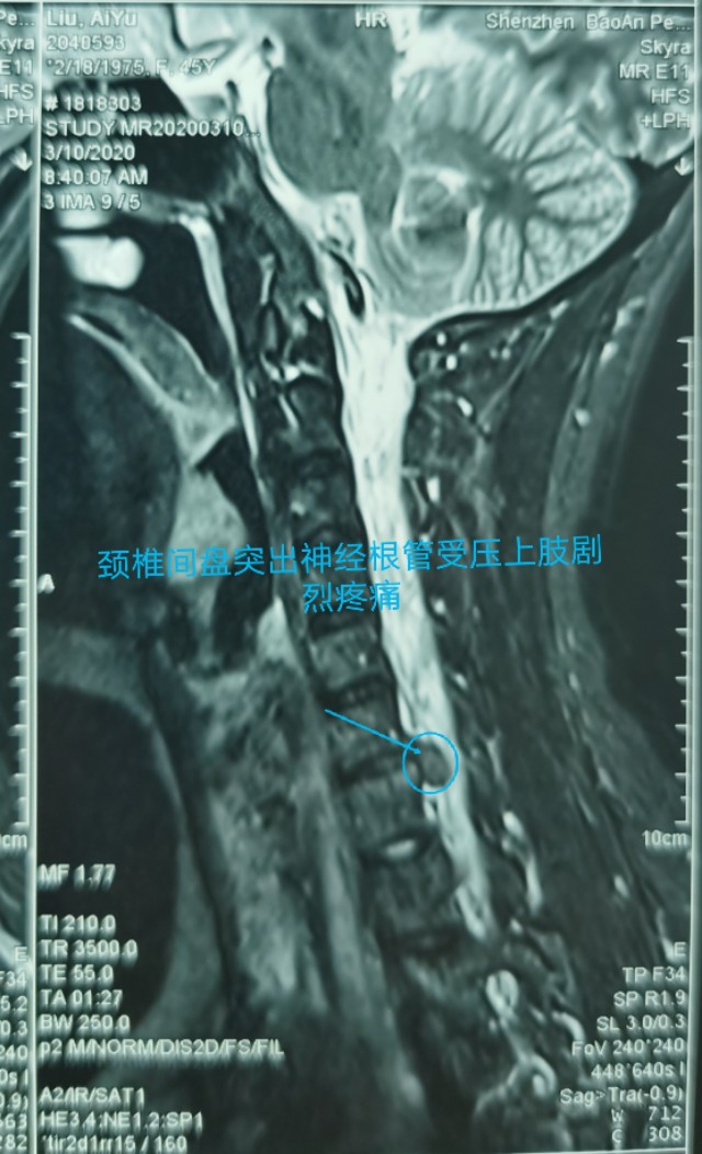 疫情期间颈椎病发作怎么办,疫情间躺久了头昏眼胀怎么治