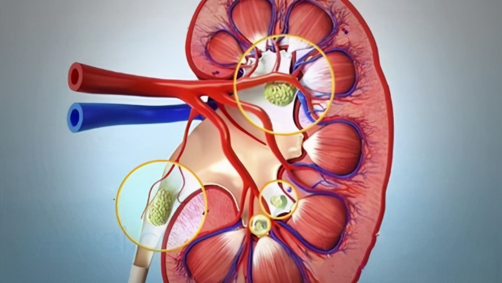 体外碎石和激光的副作用和危害,输尿管结石超声波碎石后的副作用