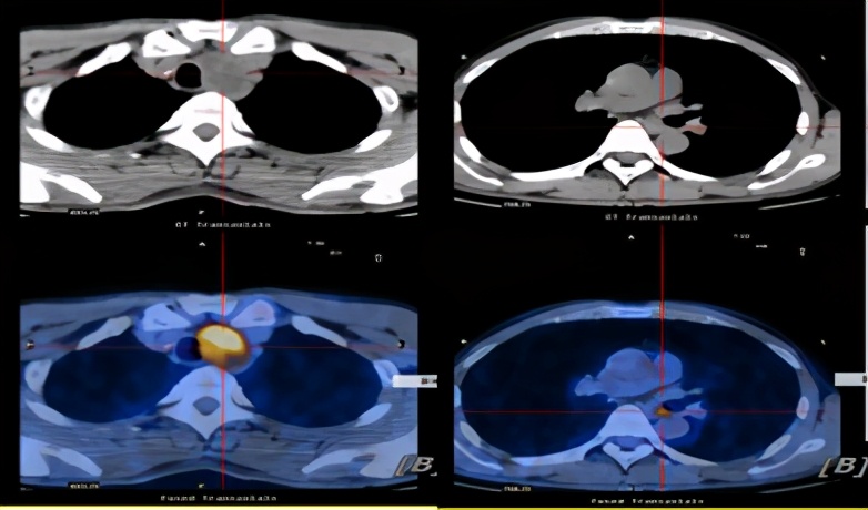 不可切除肺癌肿瘤治疗方法,不可切除晚期治疗什么意思