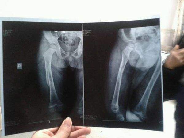 骨折卧床老人护理知识和技巧,儿童骨折后怎么照顾