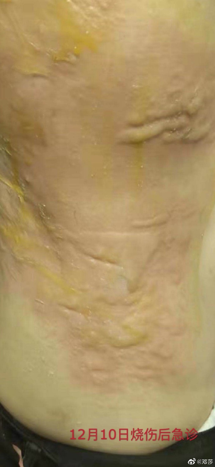 拔火罐被烧伤的明星,拔火罐明星烧伤