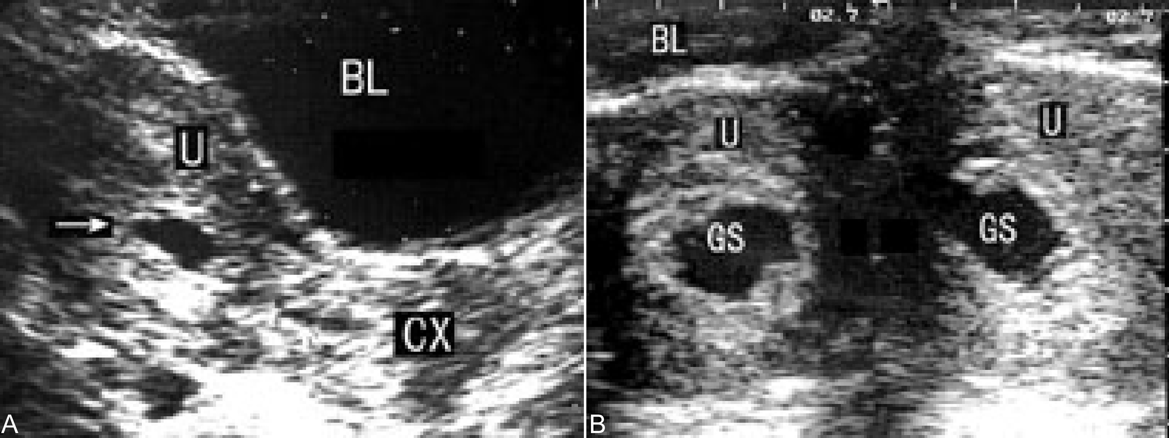 明明白白做超声32-3:流产:超声检查