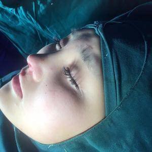 女人打玻尿酸的表现,女人经常打玻尿酸10年