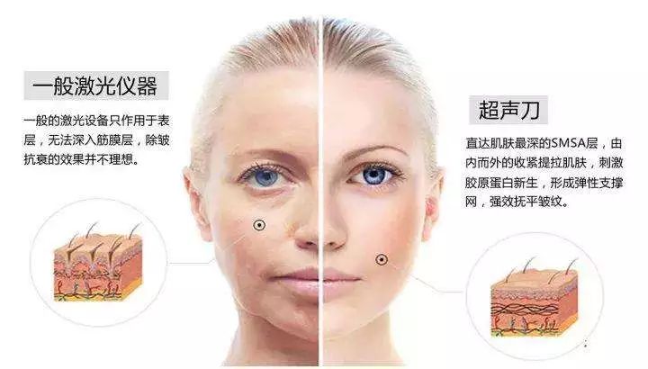超声刀能抚平皱纹吗,超声刀让人更快衰老吗