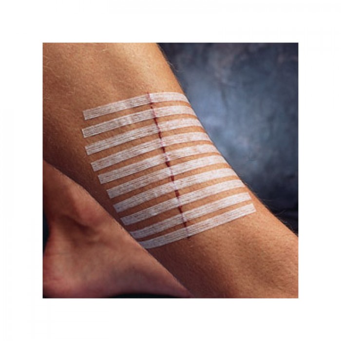 手割破了用创可贴吗,刚刚割伤后的疤痕如何消除