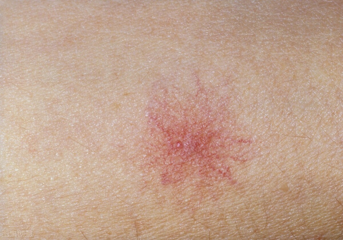 鐨偆绾㈢偣鎬庝箞鍥炰簨,濠村効鐨偆鍑虹幇绾㈢偣