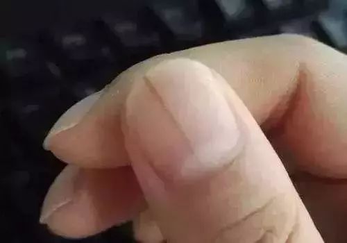 指甲上月牙少是什么问题,指甲月牙少了怎么回事